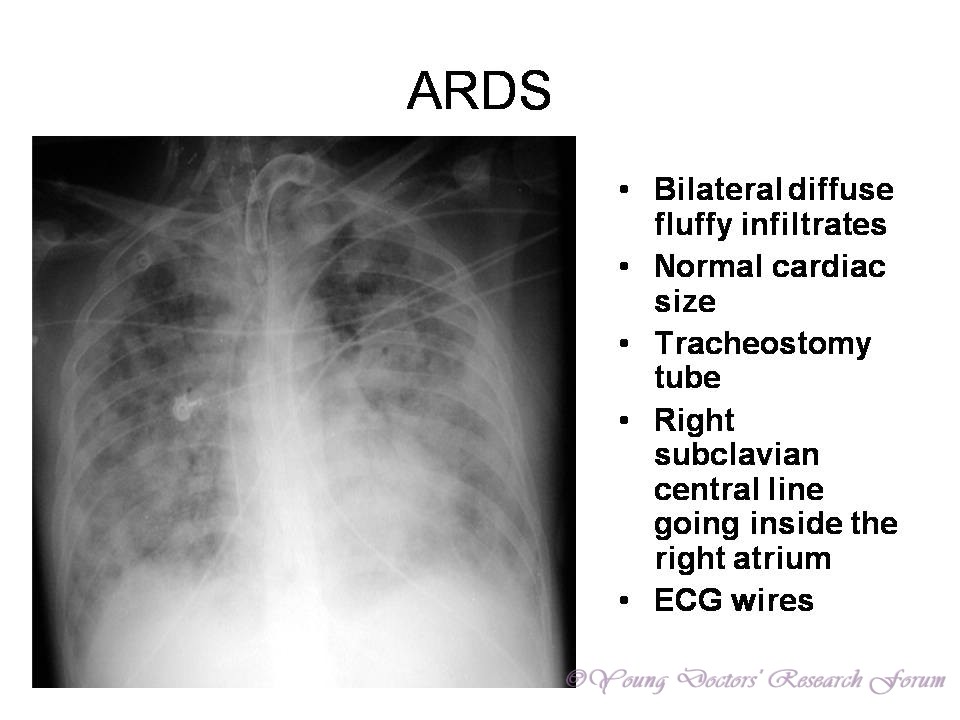 acute adult disease respiratory acute adult disease respiratory